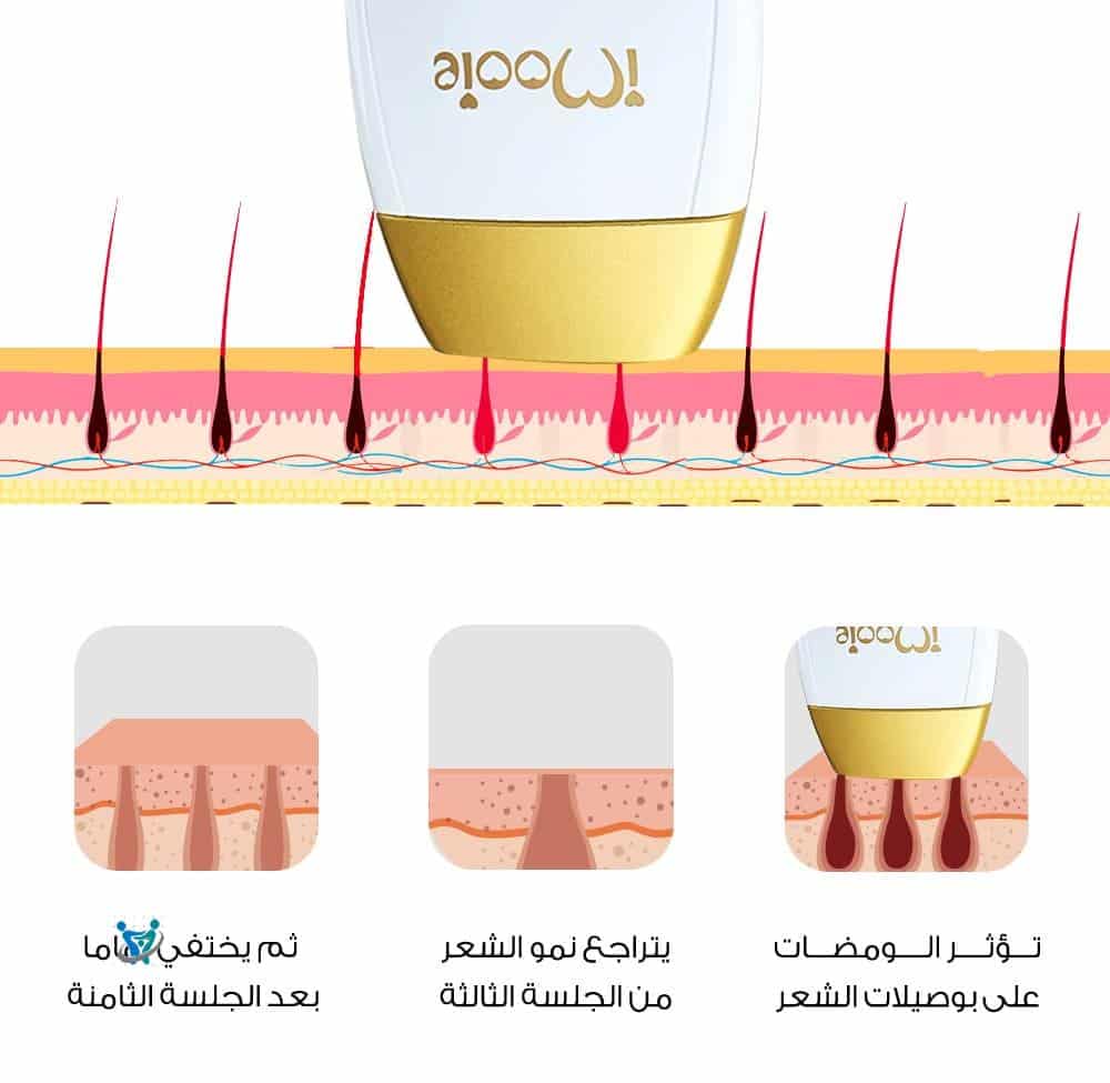 أفضل جهاز ليزر منزلي ومضات لا نهائية 1 أفضل جهاز ليزر منزلي ومضات لا نهائية
